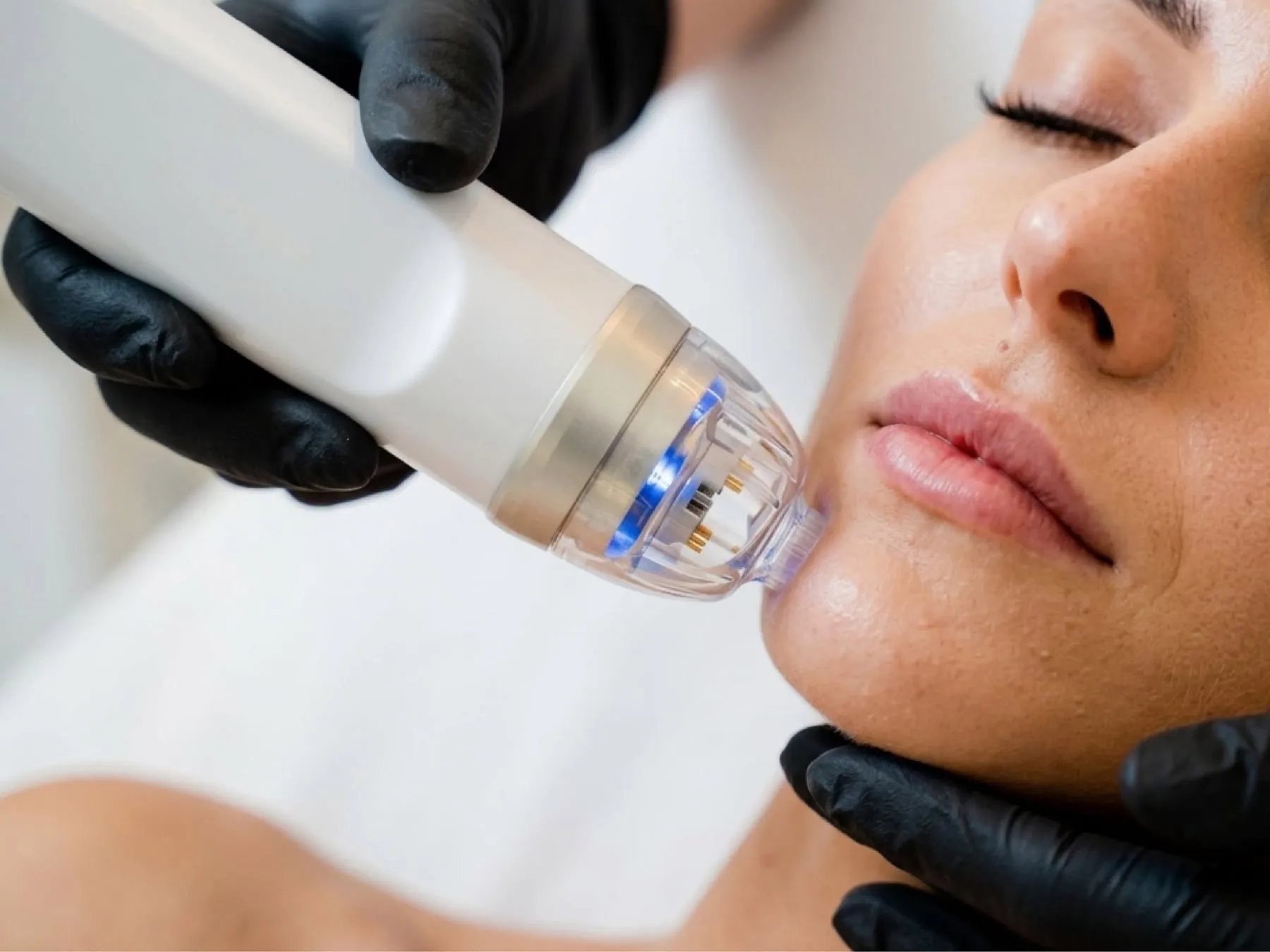 Microneedling at 360° Aesthetics Tijuana