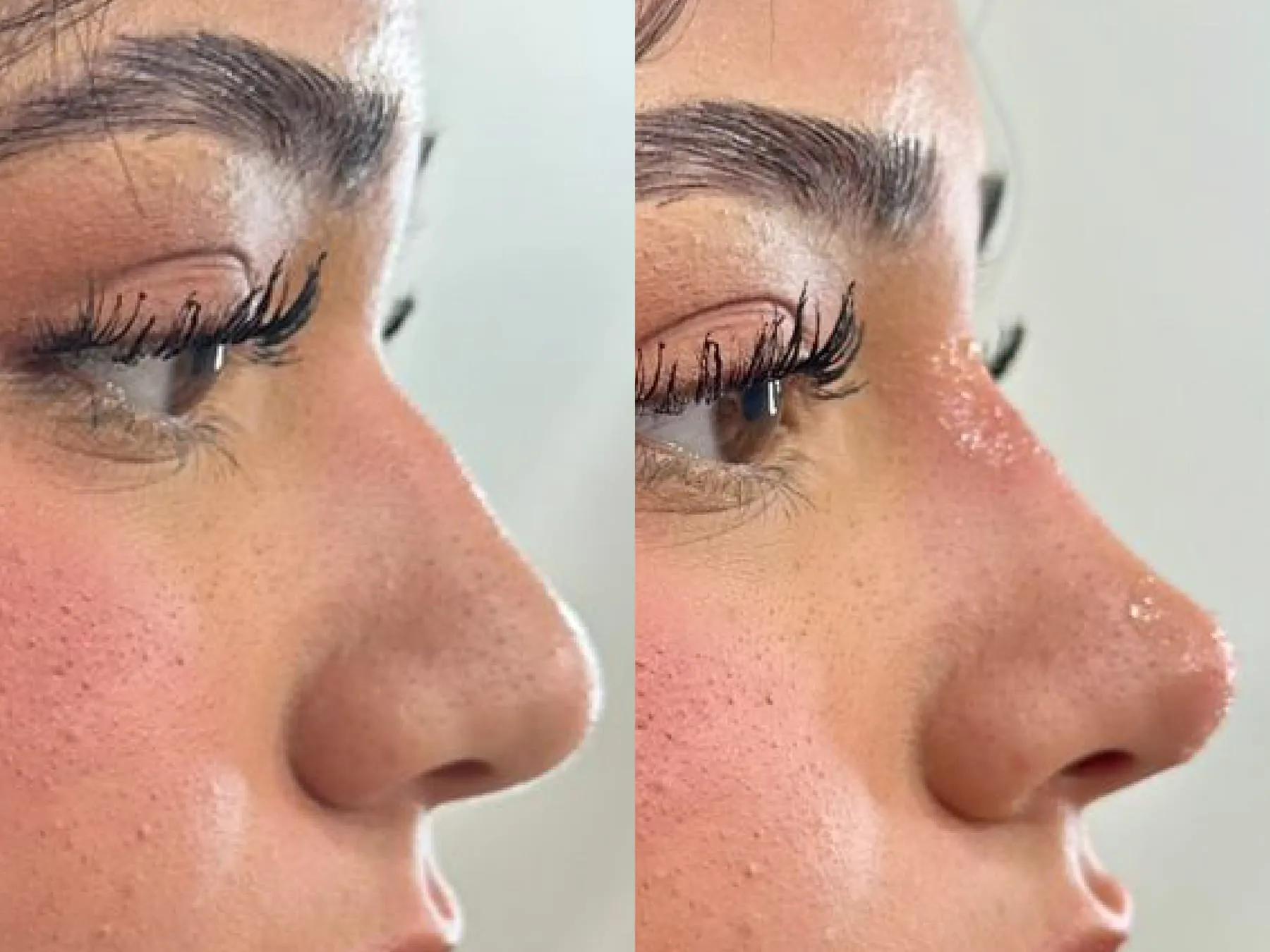 Nose Fillers at 360° Aesthetics Tijuana