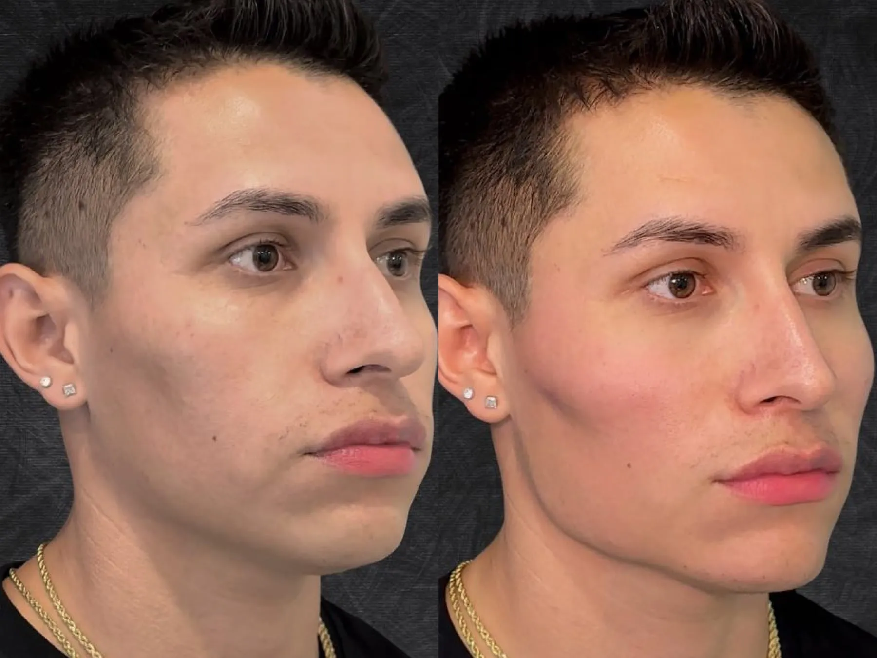Radiesse Face at 360° Aesthetics Tijuana