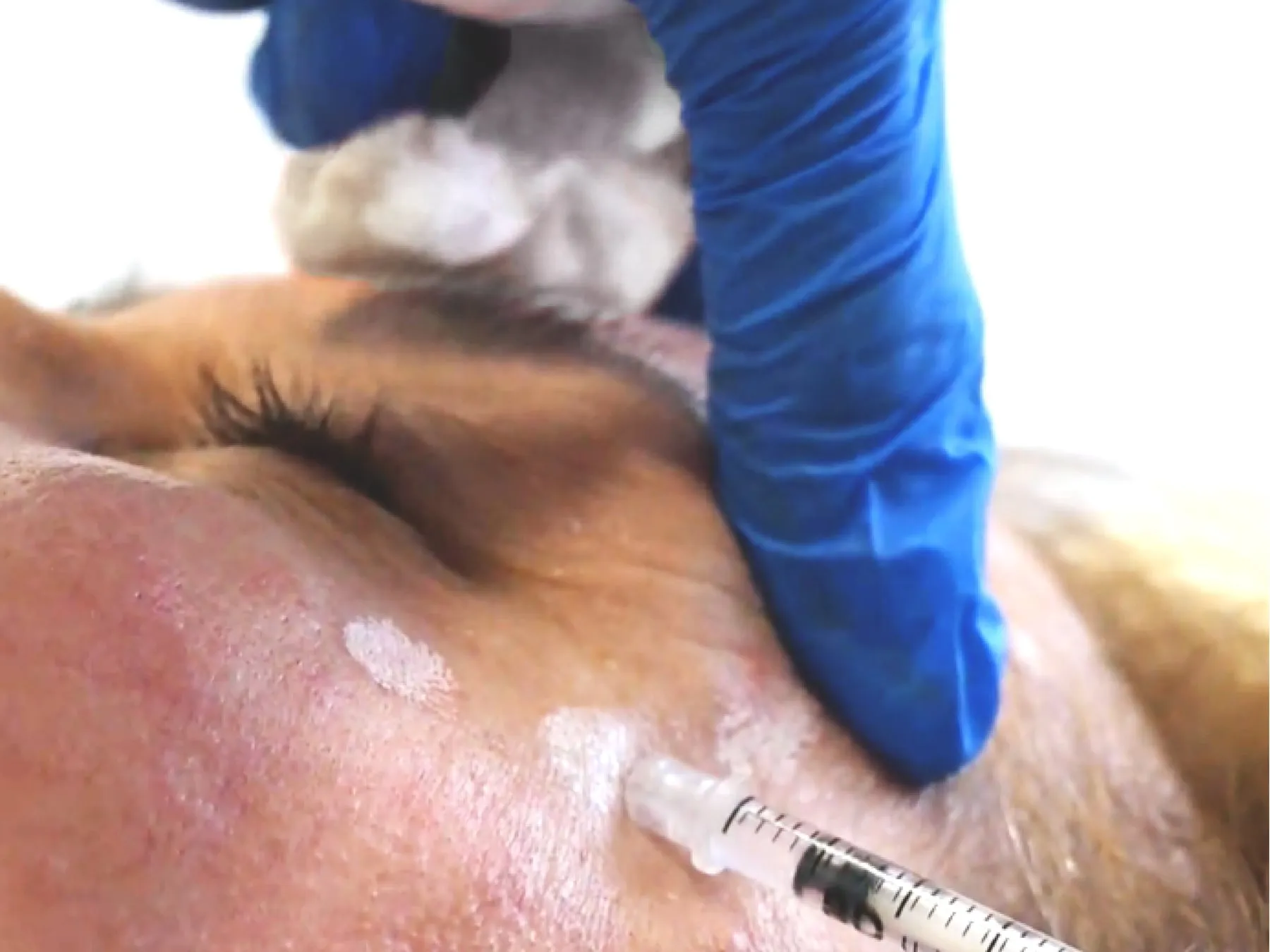 Glabella & Crow's Feet Botox at 360° Aesthetics Tijuana
